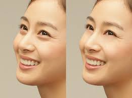 Bọng mắt - Hình ảnh minh họa